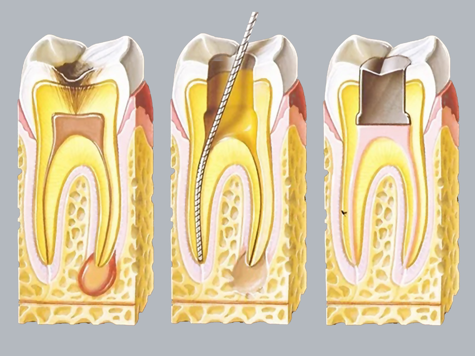endodoncia en Madrid