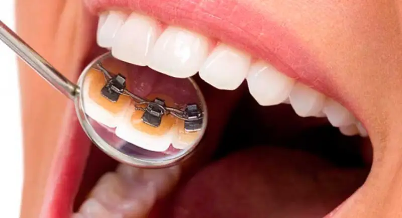 Que-son-los-brackets-linguales (1)