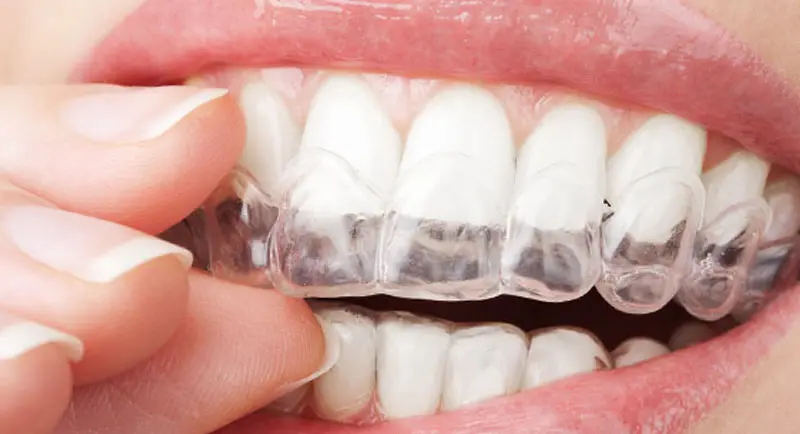 invisalign