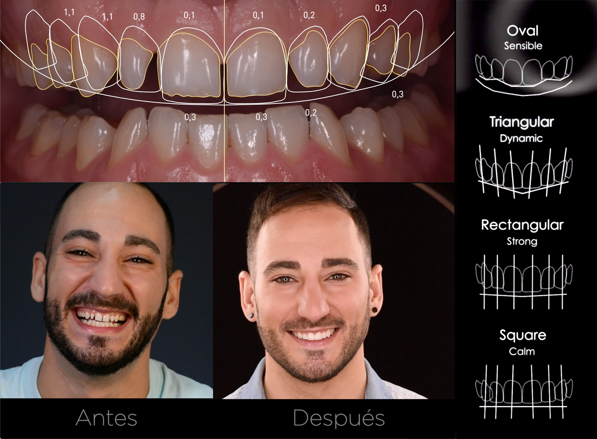 Software de simulación de sonrisa 3D para tratamientos de estética dental en Carabanchel.