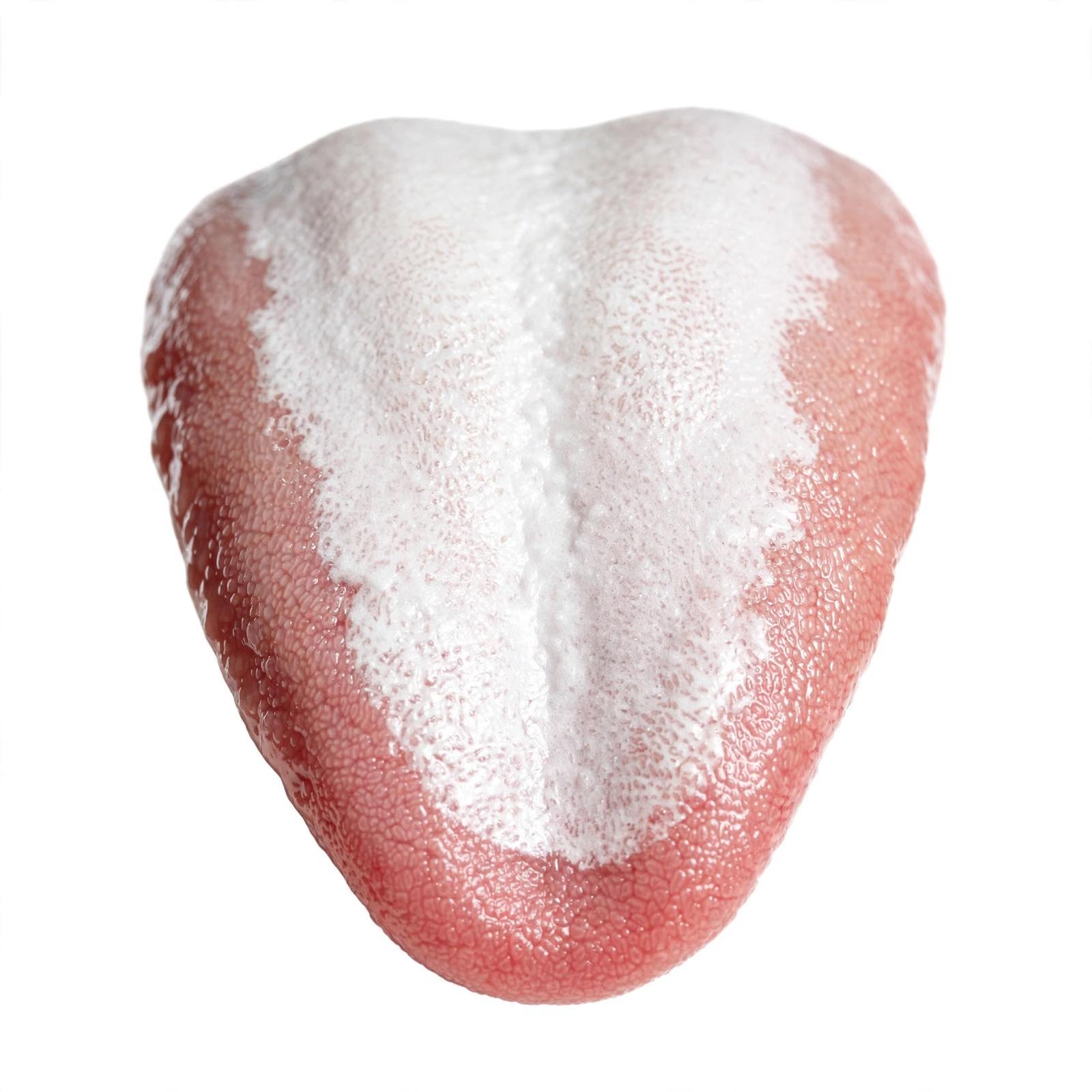 Lengua con saburra blanquecina, signo de disbiosis oral y halitosis