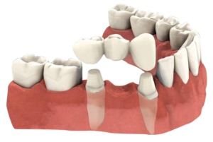 protesis_dentales_fijas_en_madrid